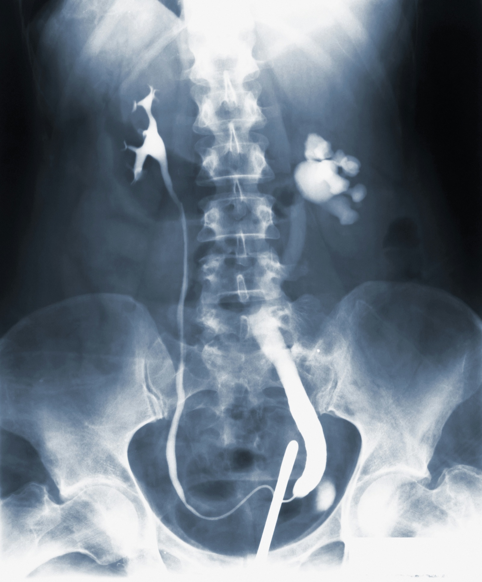 An X-ray image of the lower spine
